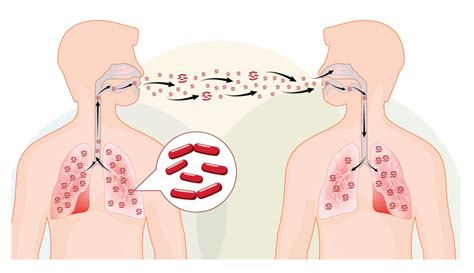 how contagious is tb