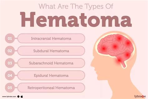how serious practical a hematoma