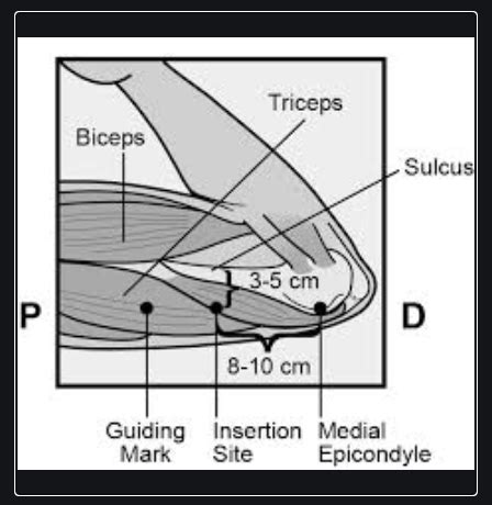 how deep should nexplanon be inserted