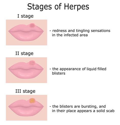 how do i know when to kiss herpes