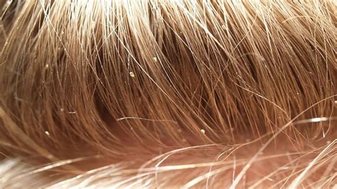 how do you detect head lice symptoms