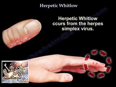 how do you get a whitlow