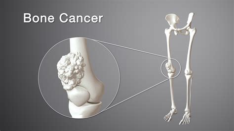 how does bone cancer develop