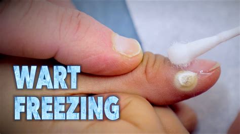 how does freezing warts work