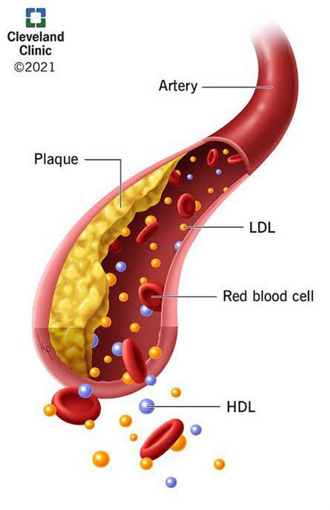 How Does Hyperlipidemia Affect Cell Fluidity