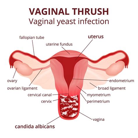 how does one get a yeast infection
