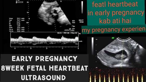 how early to detect heartbeat in pregnancy