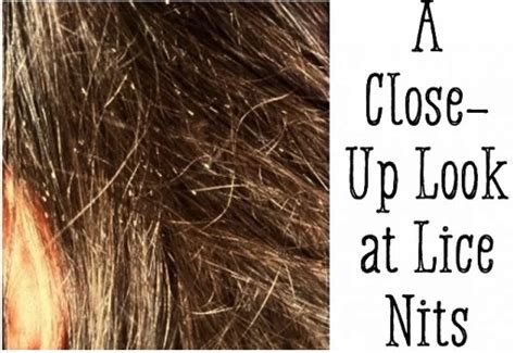 how easy is it to catch lice