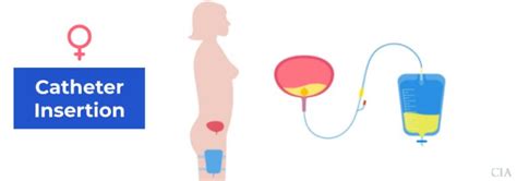 how far to insert catheter in female