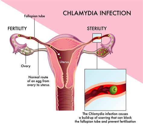 how fast does chlamydia develop
