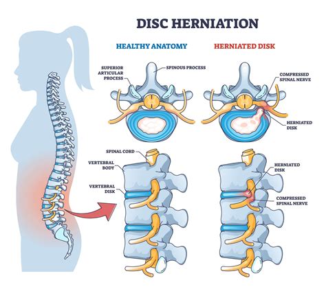 how is a herniated disc diagnosed