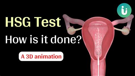 how is a hsg test done