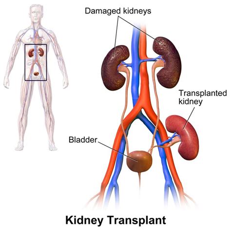 how is a kidney transplant done