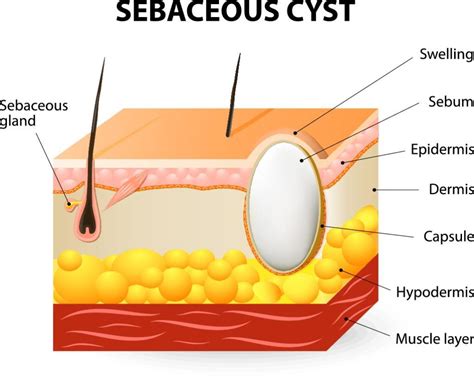 how is a sebaceous cyst formed