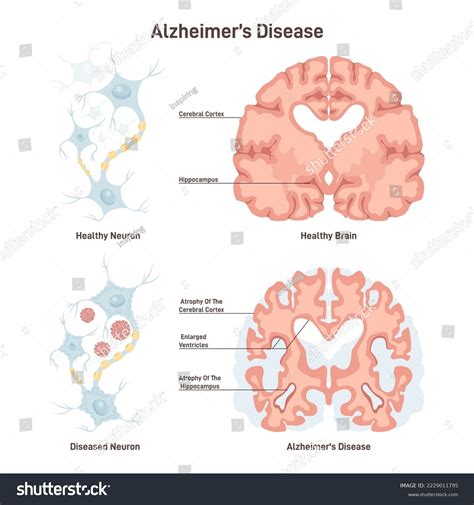 how is alzheimers transmitted