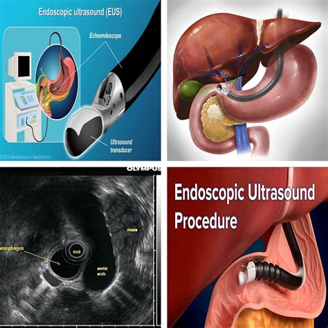how is an endoscopic ultrasound performed