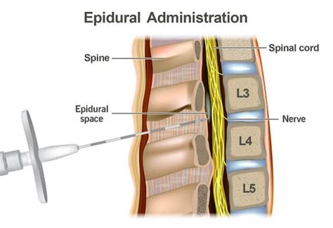 how is an epidural administered