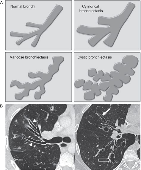 how is bronchiectasis diagnosed