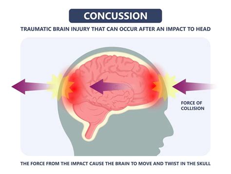 how is concussion treated in hospital