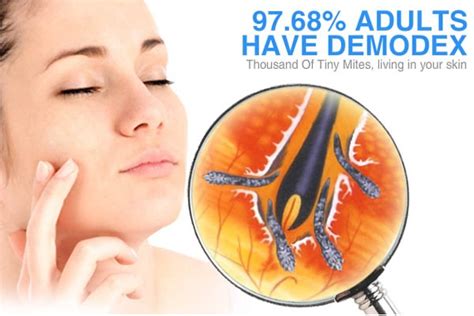 how is demodex transmitted