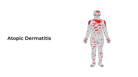 how is dermatitis caused