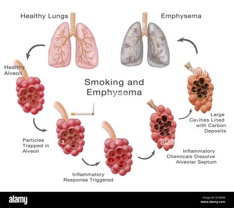 how is emphysema spread