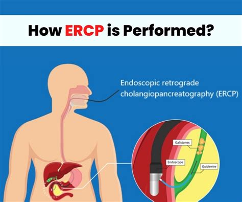 how is ercp performed