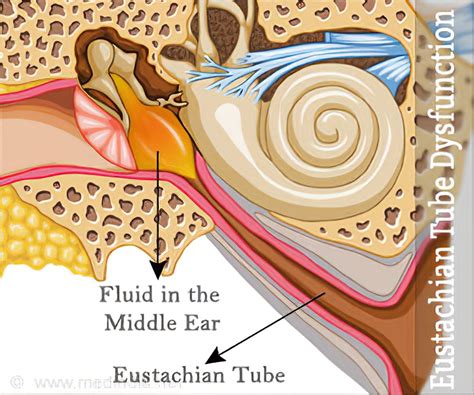 how is eustachian tube dysfunction diagnosed