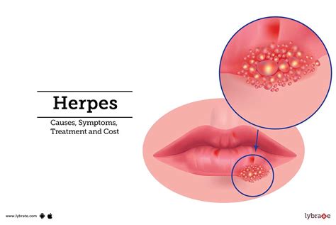 how is herpes passed onto others