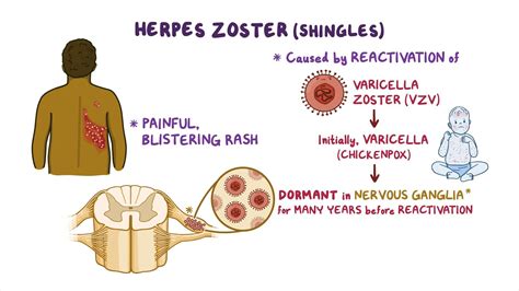 how is herpes zoster transmitted