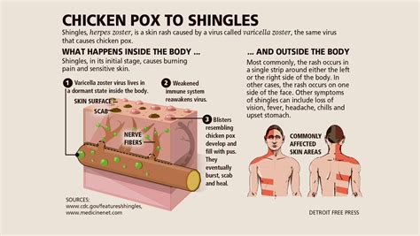 how is shingles related to chickenpox