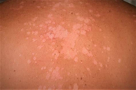 how is tinea versicolor spread