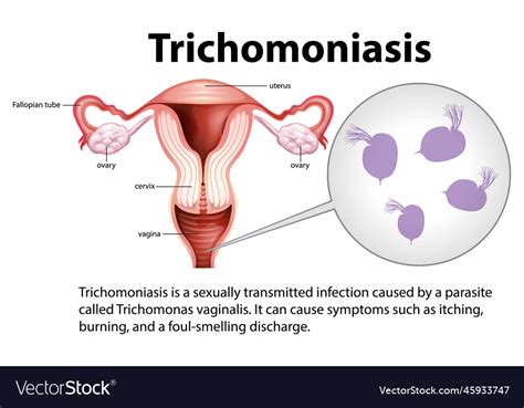 how is trichomoniasis developed