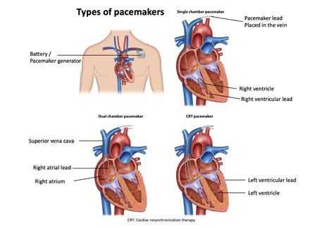 how large is a pacemaker