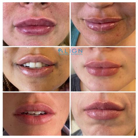 how long are your lips swollen after injections