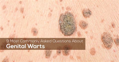 how long do hpv warts stay