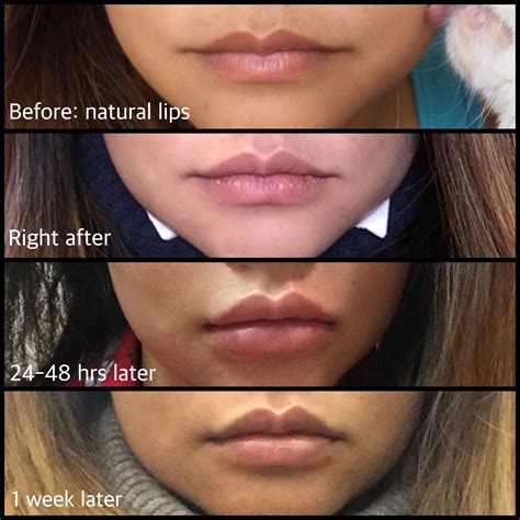how long do lips stay swollen after filler