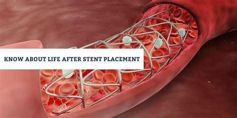 how long does a stent placement take