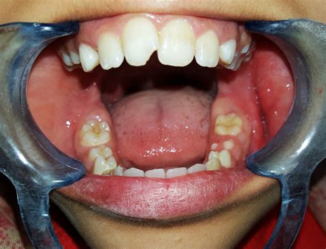 how long does a swollen tooth last
