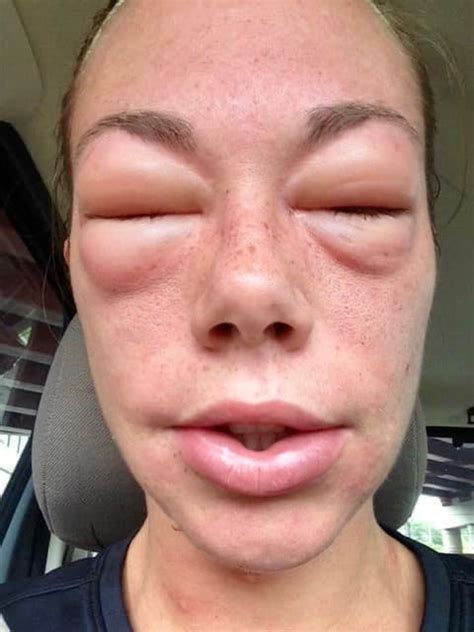 how long does allergy face swelling last