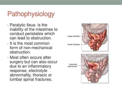 how long does paralytic ileus last