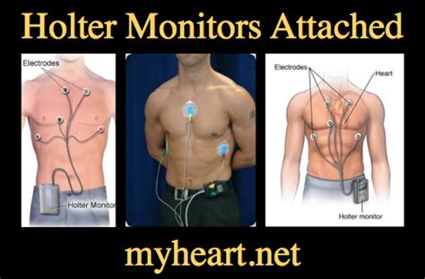 how long is a holter monitor worn