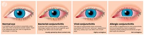 how long is conjunctivitis contagious uk