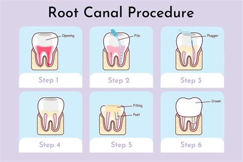 how long is root canal process