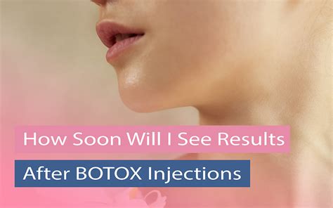 how long should botox take to work