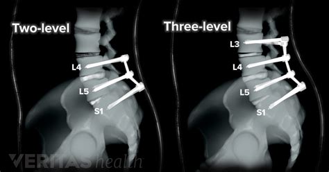 how long to heal from spinal fusion