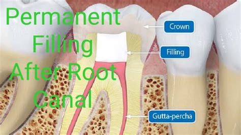 how long to wait for permanent filling after root canal