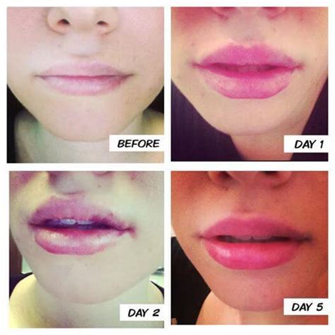 how long will a lip stay swollen