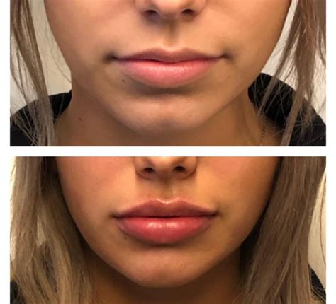 how long will lips be swollen after juvederm