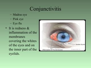 How Madras Eye Spread